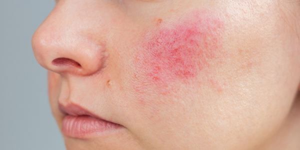 Gezicht couperose en rosacea