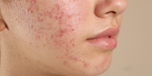 Gezicht met acne huid