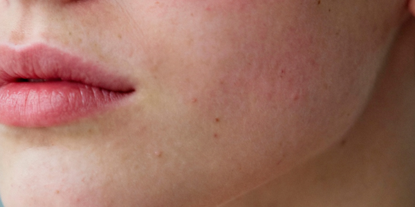 Gezicht met gevoelige huid en roodheid