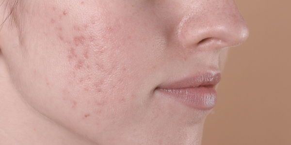 Gezicht met littekens