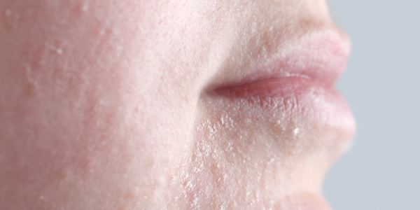 Gezicht schilferig droog